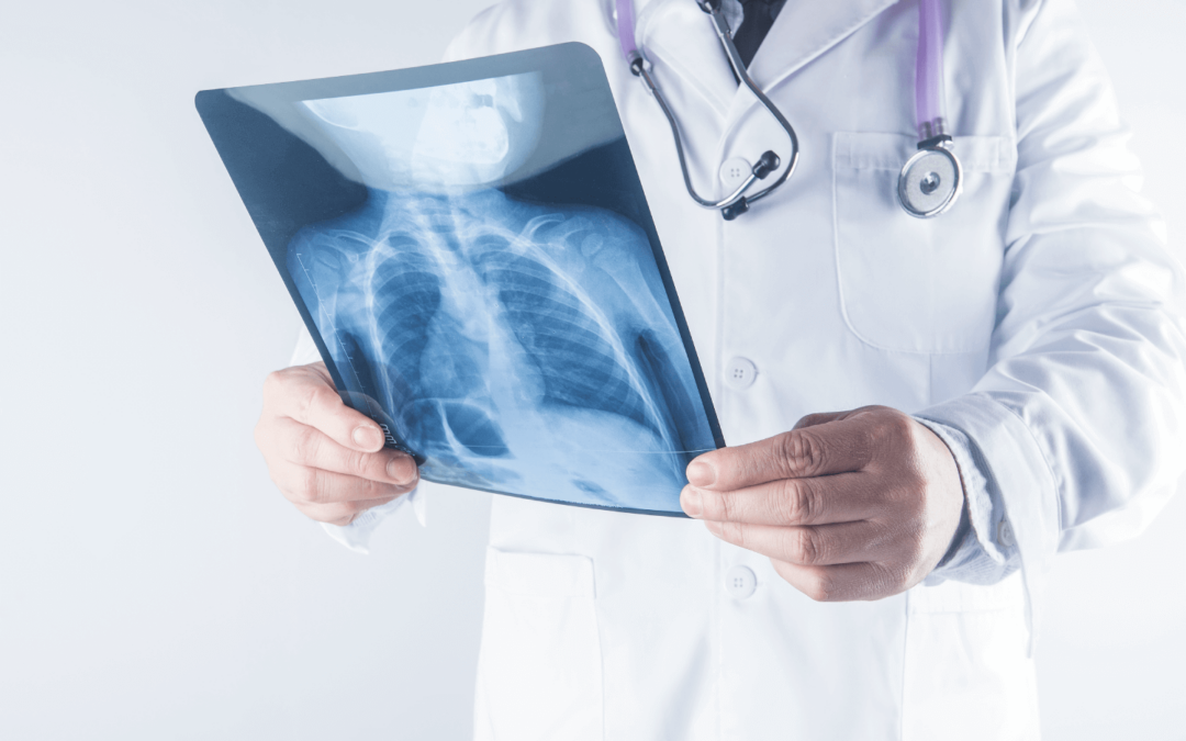 Câncer de pulmão: sintomas, diagnóstico e tratamento