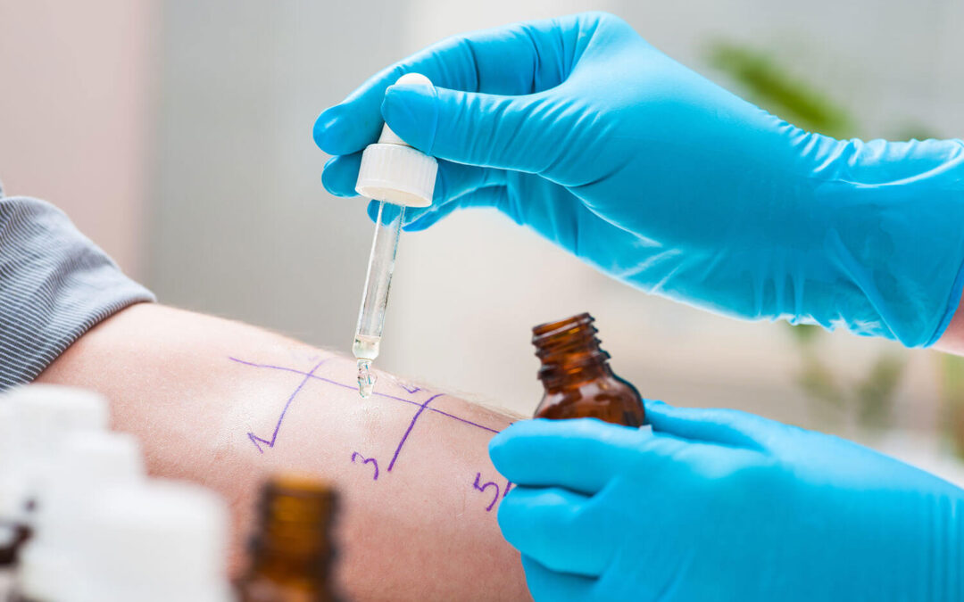 Prick Test (teste cutâneo): teste de alergias